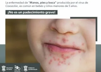 Conoce Cómo Prevenir El Virus Coxsackie Que Afecta A Menores De 5 Años
