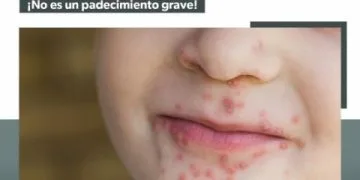 Conoce Cómo Prevenir El Virus Coxsackie Que Afecta A Menores De 5 Años