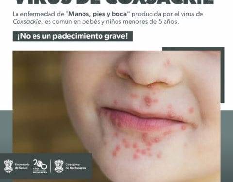 Conoce cómo prevenir el virus coxsackie que afecta a menores de 5 años