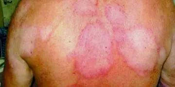 Ssm En Alerta En La Región Apatzingán Por 4 Casos De Lepra Detectados 22 Michoacán Ha Exportado Más De 70 Mil Toneladas De Mango