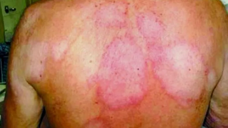 Ssm En Alerta En La Región Apatzingán Por 4 Casos De Lepra Detectados 20 Michoacán Ha Exportado Más De 70 Mil Toneladas De Mango