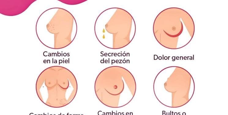 Reconoce los síntomas del cáncer de mama para actuar de inmediato 1 los sintomas del cancer de mama - El Día de Michoacán