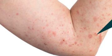 Ssm Se Suma A Acciones De Lucha Contra La Lepra