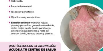 Identifica Los Síntomas Del Sarampión Y Protege Tu Salud: Ssm