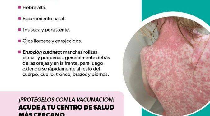 Identifica los síntomas del sarampión y protege tu salud: SSM