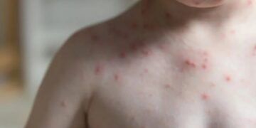 Confirma Ssm Primeros Casos De Sarampión En Michoacán 24 Entrega Alfonso Martínez Nombramiento A Pablo Alarcón Como Encargado De La Comisión Municipal De Seguridad Ciudadana