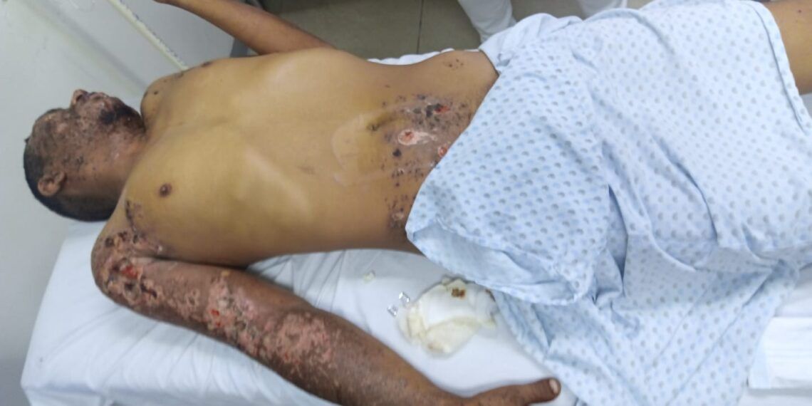 Joven Desaparecido Regresa A Casa Con Graves Quemaduras En Apatzingán
